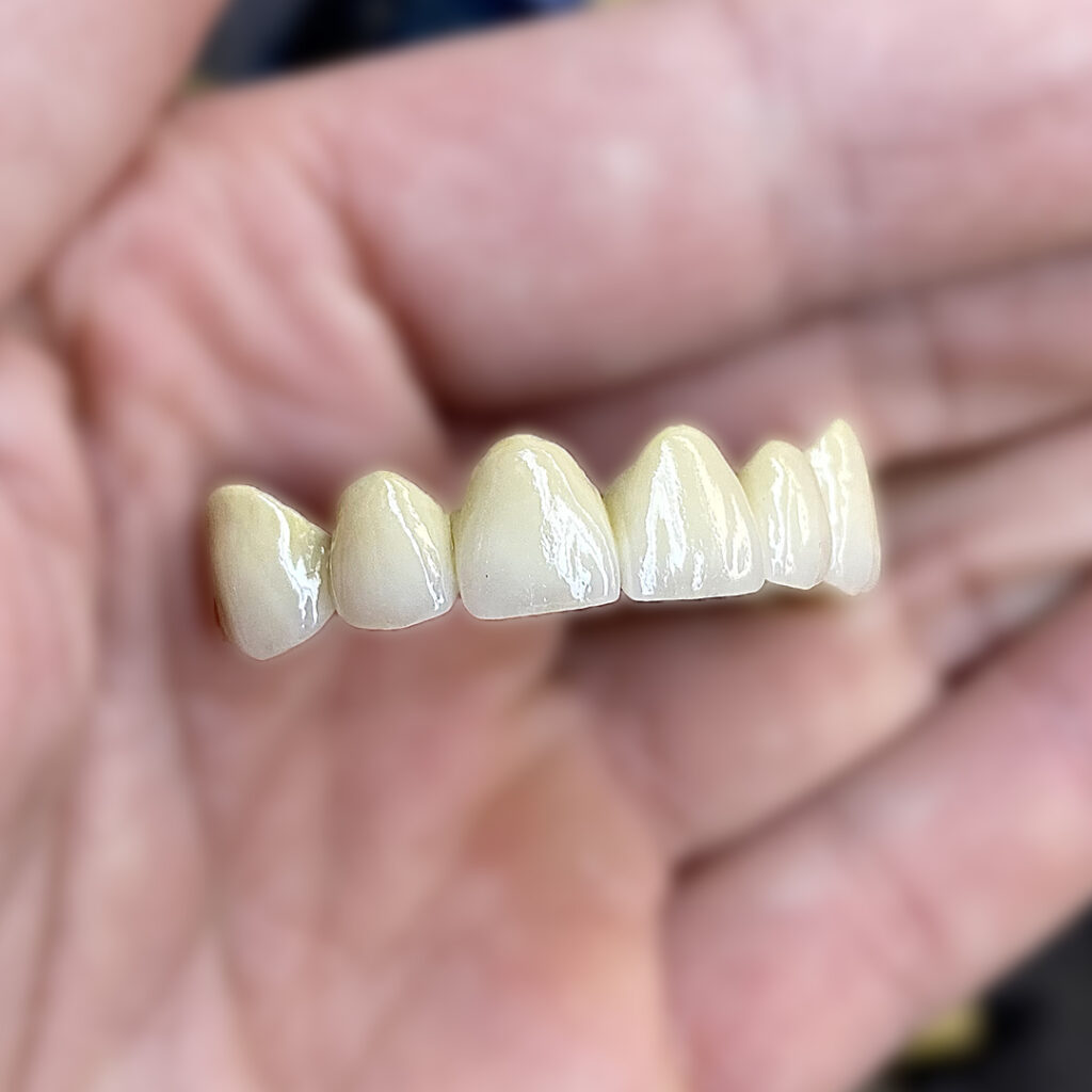 зубы металлокерамика мосты